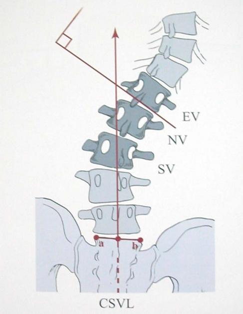 脊柱侧弯-端椎中立椎稳定椎