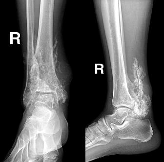 右踝骨化性肌炎